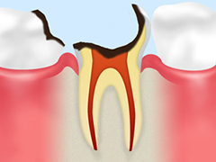 C4歯根まで達した虫歯
